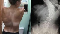 Tidak diketahui pasti mengapa anak-anak dan remaja rentan mengalami skoliosis namun diduga karena faktor genetik. (Foto: Instagram/story_of_scoliosis)