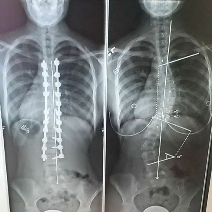 Foto Dampak Skoliosis pada Penyandangnya, Punggung Jadi Foto Dampak Skoliosis pada Penyandangnya, Punggung Jadi