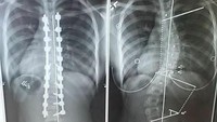 Untuk memperbaiki skoliosis ringan pasien biasanya diberikan penyangga supaya tidak makin parah. Namun bila tulang sudah sangat miring maka solusinya adalah operasi penanaman sekrup dan lempengan baja untuk meluruskan tulang. (Foto: Instagram/everfreemoonlight)