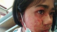 Seorang anak bernama Phakamad Sangchai dari Thailand juga disebut-sebut mengidap hematohidrosis. Tidak diketahui pasti apa penyebabnya namun seringkali darah keluar ketika penyandangnya sedang merasa stres atau tertekan. (Foto: Facebook/Win Ko)