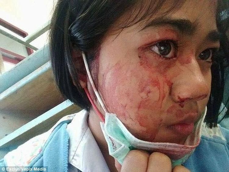 Orang-orang Berkondisi Langka yang Bisa Mengeluarkan Keringat Darah