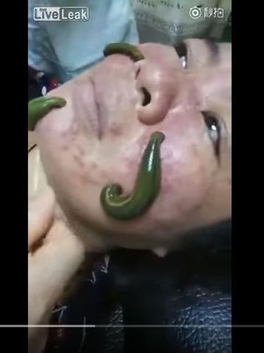 Benarkah Jerawat Bisa Sembuh dengan Facial Lintah? Ini Kata Dokter Kulit