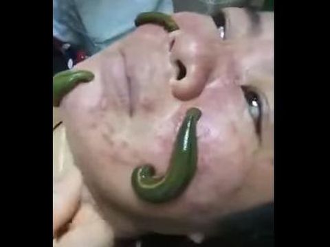 Ngeri, Wanita Ini Facial Wajah Pakai Lintah untuk Sedot Jerawat