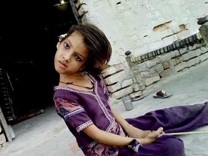 Penyakit Misterius Bikin Kepala Anak Ini Miring 90 Derajat