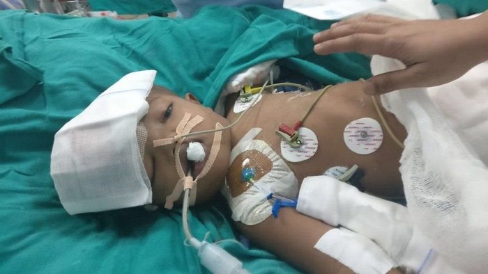 Bayi Kembar Siam yang Dipisahkan di India Akhirnya Membuka Mata