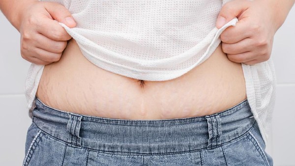 Ini Dia Orang-orang yang Berisiko Memiliki Stretch Mark
