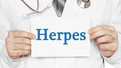 Ini Cirinya Terkena Herpes Genital
