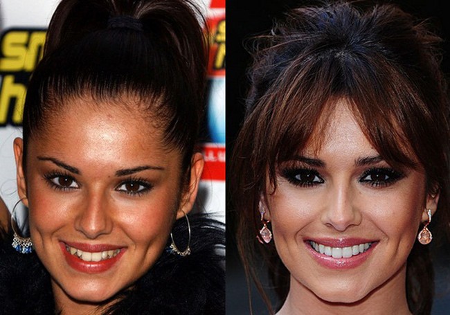 Gigi gingsul Cheryl sebenarnya sudah cukup manis. Tapi setelah dibuat lebih rata, ia jadi tampak lebih percaya diri tersenyum. Foto: Getty Images