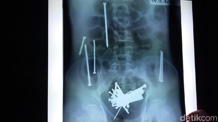 Paku di Dalam Perut Wawan asal Tasikmalaya