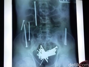 48 Paku Karatan Bersarang di Perut Wawan Berujung Maut