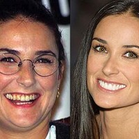 Dulu, gigi Demi Moore kuning dan tidak rata. Kini giginya putih cemerlang dan sangat rapi. Foto: Getty Images