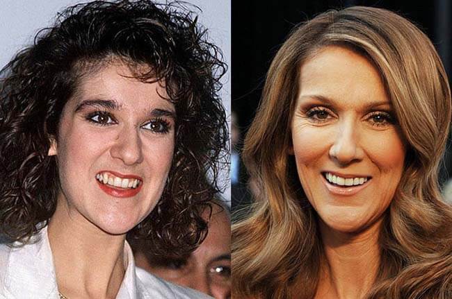 Celine Dion juga memiliki gigi tak rata dan gingsulnya sangat panjang. Setelah diperbaiki, wajahnya terlihat lebih proporsional. Foto: istimewa