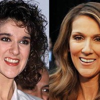 Celine Dion juga memiliki gigi tak rata dan gingsulnya sangat panjang. Setelah diperbaiki, wajahnya terlihat lebih proporsional. Foto: istimewa