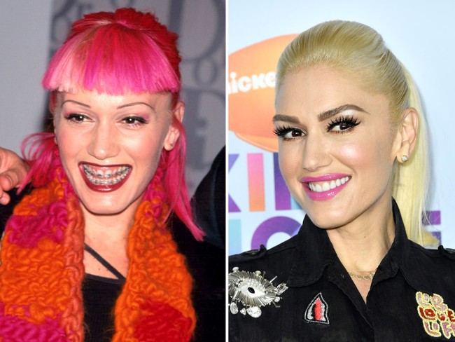 Gwen Stefani dulunya memakai kawat gigi untuk menyempurnakan penampilannya. Tak sia-sia, kini senyumnya lebih menarik. Foto: Getty Images