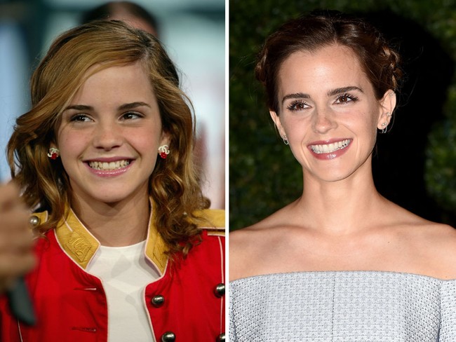 Senyum yang indah memang bisa mempercantik wajah seseorang. Emma Watson adalah bukti nyata. Lihat penampilannya di awal-awal kemunculan saat giginya masih berantakan serta bergingsul dan sekarang. Foto: Getty Images