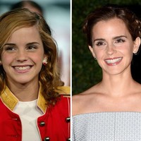 Senyum yang indah memang bisa mempercantik wajah seseorang. Emma Watson adalah bukti nyata. Lihat penampilannya di awal-awal kemunculan saat giginya masih berantakan serta bergingsul dan sekarang. Foto: Getty Images