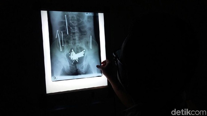Paku di Dalam Perut Wawan asal Tasikmalaya
