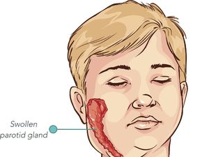 Mitos atau Fakta Belau Ampuh Atasi Gondongan? Ini Penjelasan Dokter