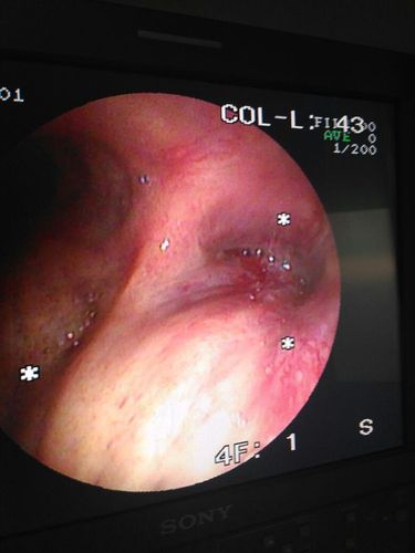 Penampakan Saluran Napas yang Tertutup Kanker, Masih Mau Merokok?