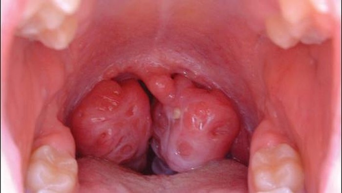 Penyebab Radang Amandel, Ciri-ciri, Makanan Pemicu, dan Cara Mengobatinya