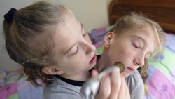 Abigail dan Brittany Hensel adalah pasangan kembar dempet asal Minnesota. Keduanya menjadi bukti bahwa beberapa kembar dempet dapat bertahan hingga dewasa.
