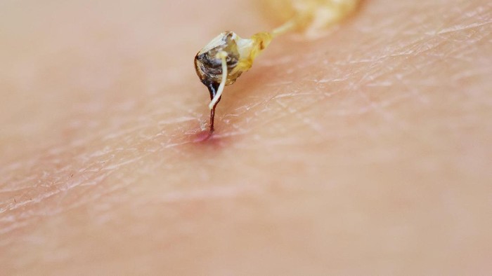 Tips Atasi Beragam Gigitan Serangga Dan Hewan Kecil Foto 3