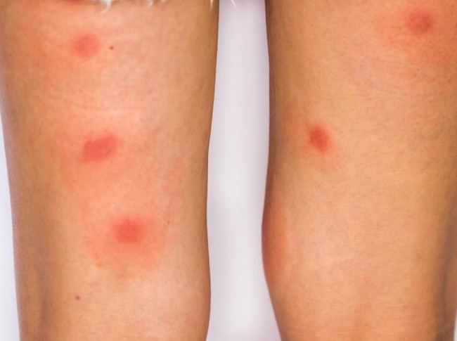 Kenali Ciri-ciri Gigitan 4 Serangga Ini pada Kulit (2)