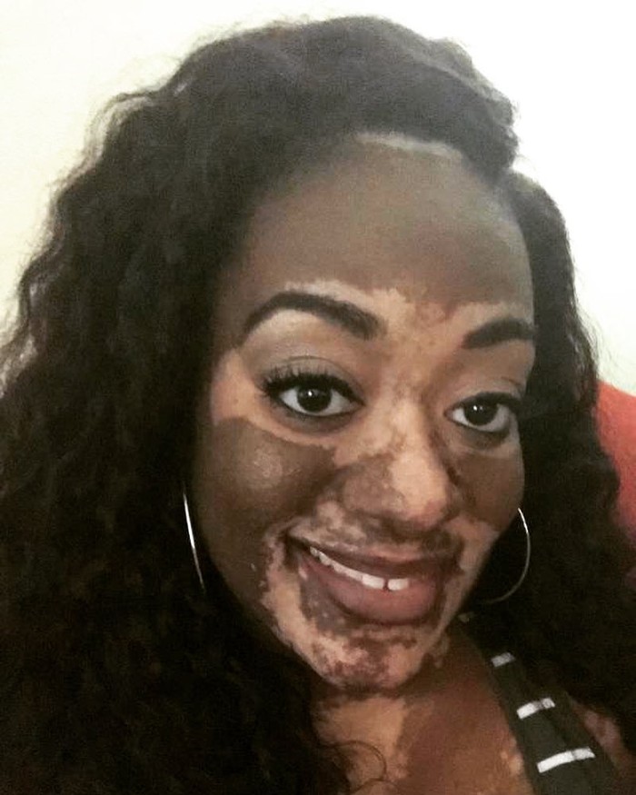 Kandice Benford setelah alami vitiligo. Foto: instagram @kandif5 Kandice Benford setelah alami vitiligo. Foto: instagram @kandif5