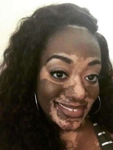 Stres Urus Pernikahan, Kulit Wanita Ini Jadi Belang-belang dalam Semalam 