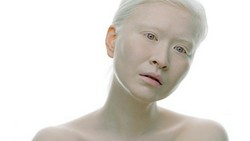 Albinisme adalah kelainan genetik yang membuat pengidapnya kekurangan atau tidak memiliki pigmen warna. Seperti yang dialami oleh Connie Chiu.