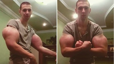 Penampakan Lengan Popeye Hasil Suntikan Minyak
