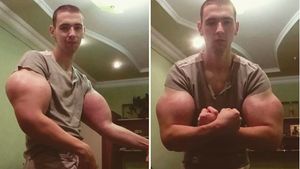Penampakan Lengan Popeye Hasil Suntikan Minyak