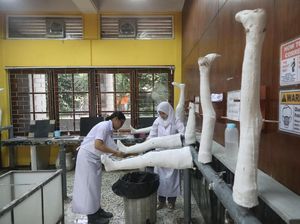 Kisaran Harga Kaki Palsu, Ditanggung BPJS Kesehatan Nggak?