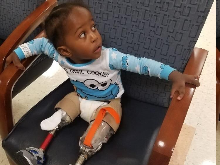 Ini Jaylen, Bisa Jalan Lagi Setelah Diamputasi Karena Kondisi Langka