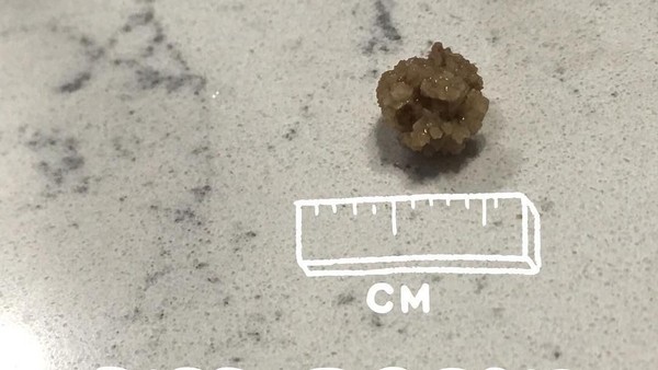 Kumpulan Penampakan Batu Ginjal, Pernah Lihat?