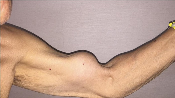 Lengan Pria Ini Jadi Besar Seperti Popeye Karena Ototnya Putus