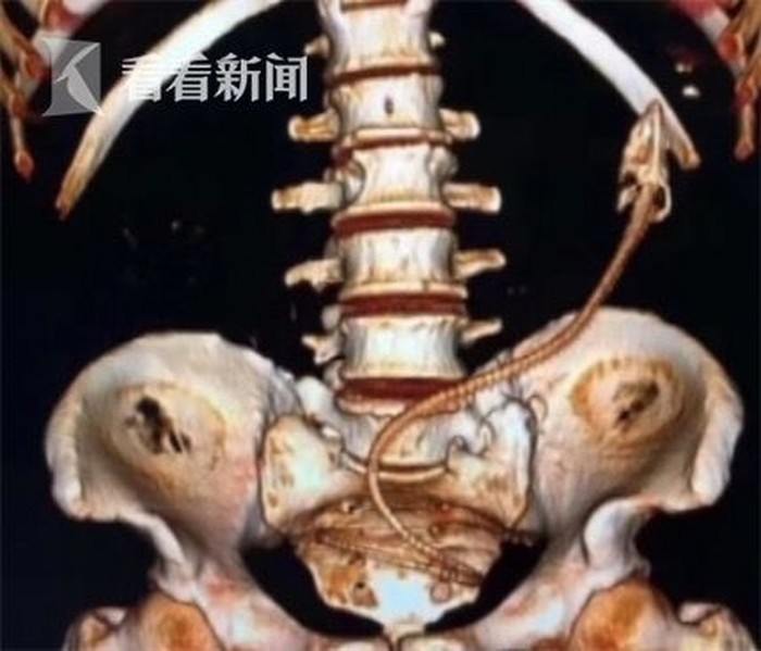 Waduh, Ada Seekor Belut Nyangkut dalam Tubuh Pria Ini