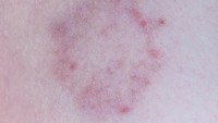 Ringworm adalah infeksi jamur yang sangat menular dan dapat menyebabkan rambut rontok apabila tumbuh di kulit kepala Anda. Saat Anda berbaring di bantal dengan rambut basah, bantal menjadi lembab. Kombinasi rambut basah dan bantal lembab mendorong pertumbuhan jamur. Hal ini juga membuat Anda lebih mungkin menginfeksi anggota keluarga lainnya, terutama jika Anda berbagi tempat tidur. (Foto: ilustrasi/Thinkstock)