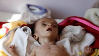Anak-anak yang menderita malnutrisi dibawa ke sentra penanganan malnutrisi di Sanaa (Foto: Dok. REUTERS/Khaled Abdullah)