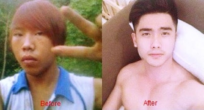 Tom Ngu Yen, pria asal Vietnam ini tak menyerah dengan keadaan genetik yang dimilikinya. Ia pun memilih operasi plastik dan kini menjadi lebih ganteng. Foto: Istimewa