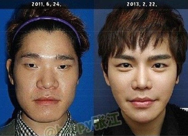 Operasi plastik di Korea menjadi hal yang wajar. Salah satunya seperti yang dilakukan oleh Kim Sang Sung yang mengubah penampilannya dengan operasi pemotongan rahang wajah, membuat hidung lebih mancung dan memperlebar kelopak mata. Foto: Istimewa