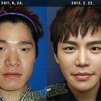 Operasi plastik di Korea menjadi hal yang wajar. Salah satunya seperti yang dilakukan oleh Kim Sang Sung yang mengubah penampilannya dengan operasi pemotongan rahang wajah, membuat hidung lebih mancung dan memperlebar kelopak mata. Foto: Istimewa