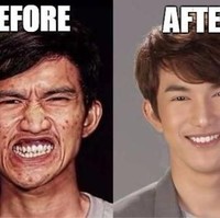 Pria bernama Noppajit Monlin ini sangat tak percaya diri dengan penampilannya dan merasa malu karena wajahnya dipenuhi bekas jerawat. Buruh pabrik di Thailand ini kemudian jadi viral setelah menjalani operasi plastik dan wajahnya kini mirip seperti bintang K-pop Foto: Istimewa