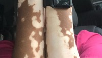 Wanita asal Richmond, Virginia ini berharap upayanya juga akan mendorong pengidap vitiligo lain agar tak malu di depan publik. Di akun Instagramnya, Sharekia juga sering memberikan edukasi tentang vitiligo lengkap dengan foto kondisinya sendiri. (Foto: Instagram/rekiawinston)