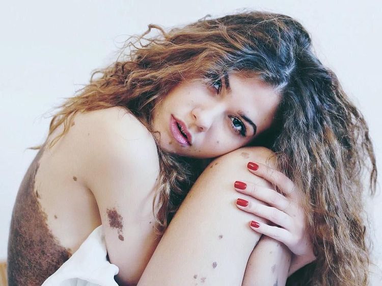 Yulianna yang Tak Malu dengan Tanda Lahir Sebadan