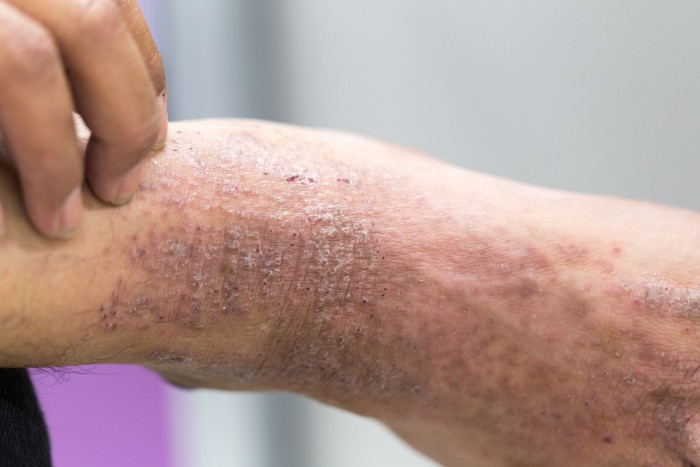 Dermatitis atau eksim adalah peradangan hebat yang menyebabkan pembentukan lepuh atau gelembung kecil (vesikel) pada kulit, sehingga bisa hingga pecah dan mengeluarkan cairan. Nah menurut, dr Michael Triangto, SpKO dari RS Mitra Kemayoran kepada detikHealth beberapa waktu lalu, hal ini bisa saja terjadi ketika memakai sepatu dalam keadaan kaki basah. (Foto: Ilustrasi/Thinkstock) Dermatitis atau eksim adalah peradangan hebat yang menyebabkan pembentukan lepuh atau gelembung kecil (vesikel) pada kulit, sehingga bisa hingga pecah dan mengeluarkan cairan. Nah menurut, dr Michael Triangto, SpKO dari RS Mitra Kemayoran kepada detikHealth beberapa waktu lalu, hal ini bisa saja terjadi ketika memakai sepatu dalam keadaan kaki basah. (Foto: Ilustrasi/Thinkstock)