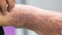 Dermatitis atau eksim adalah peradangan hebat yang menyebabkan pembentukan lepuh atau gelembung kecil (vesikel) pada kulit, sehingga bisa hingga pecah dan mengeluarkan cairan. Nah menurut, dr Michael Triangto, SpKO dari RS Mitra Kemayoran kepada detikHealth beberapa waktu lalu, hal ini bisa saja terjadi ketika memakai sepatu dalam keadaan kaki basah. (Foto: Ilustrasi/Thinkstock)