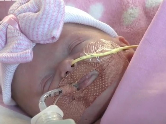 Kisah Haru Perjuangan Bayi yang Lahir dengan Jantung di Luar