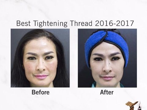 Foto Before After Iis Dahlia Lakukan Botox Hingga Tanam Benang 