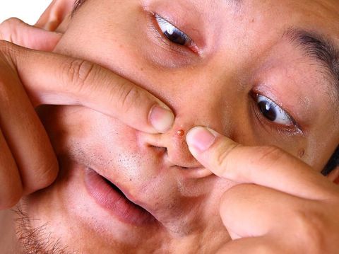 Penyebab Jerawat Di Hidung Dan Cara Menghilangkannya